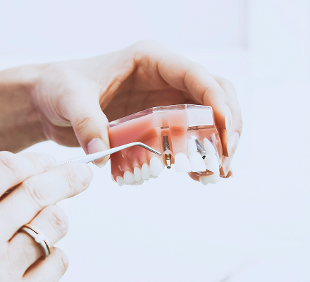Veneers